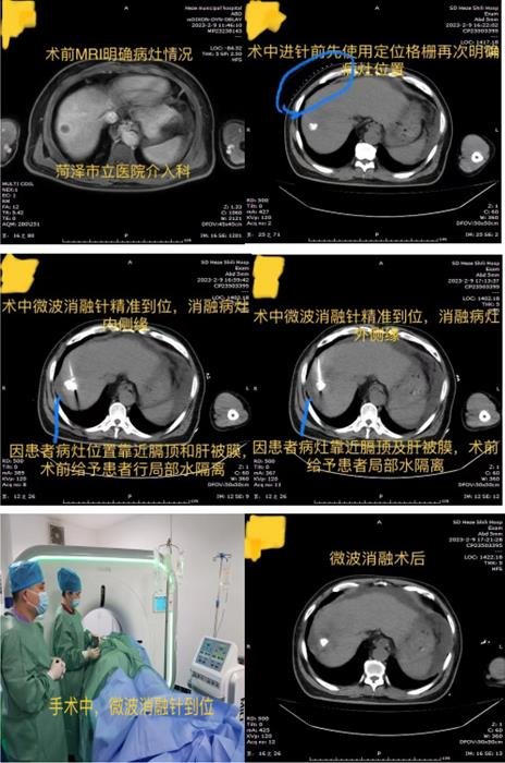 菏澤市立醫(yī)院介入科:開(kāi)展微波消融術(shù) 造福腫瘤患者